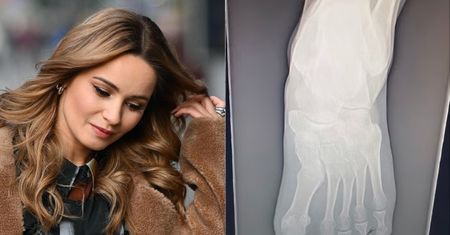 Ewelina Lisowska PRZEJECHAŁA sobie po stopie motocyklem. Pokazała nawet zdjęcie rentgenowskie. "Palce nie wyglądały za dobrze"