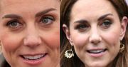 Kate Middleton wstrzykuje sobie botoks? Pałac Kensington skomentował doniesienia kliniki