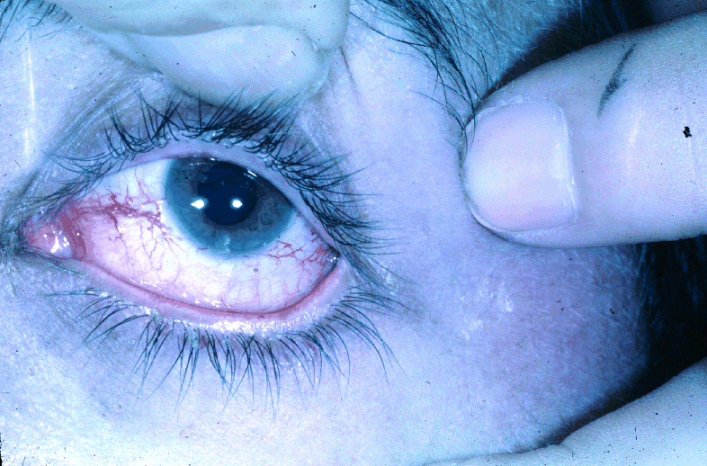 Poszerzone naczynia spojówki u pacjenta z zespołem ataksja - teleangiektazja / wikipedia