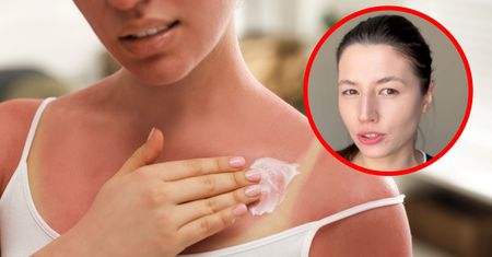 Pokazała, jak wygląda skóra po opalaniu. Od razu sięgniesz po krem z filtrem