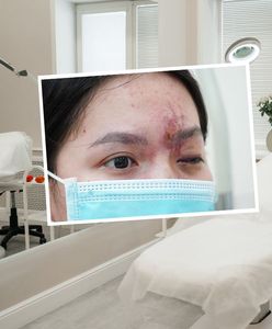 Dramat 17-latki. Straciła wzrok po zabiegu upiększającym w Wietnamie