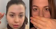 Zdecydowała się na powiększenie ust. Szybko pożałowała