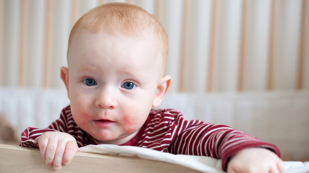 Czego nie należy podawać dziecku z alergią?