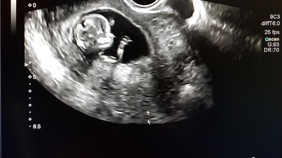 Płód w ciele noworodka. Niezwykłe odkrycie indyjskich lekarzy