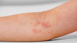 Przeczosy - charakterystyka, przyczyny, leczenie