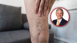 Mróz sprzyja zakrzepom. Chirurg mówi, co rozrzedza krew i pomaga na żylaki