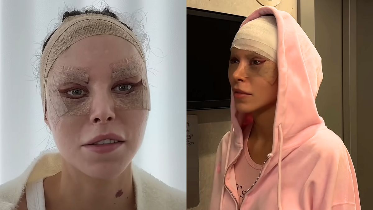 Julia von Stein prezentuje efekty drugiego liftingu twarzy