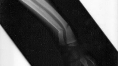 Aparaturą USG można leczyć złamania kości 1