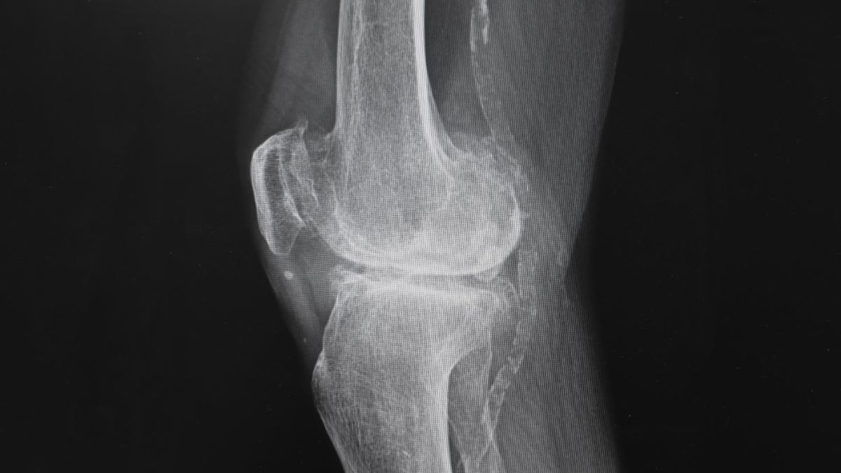 Jałowa martwica kości to schorzenie, w przebiegu którego fragment tkanki kostnej obumiera.
