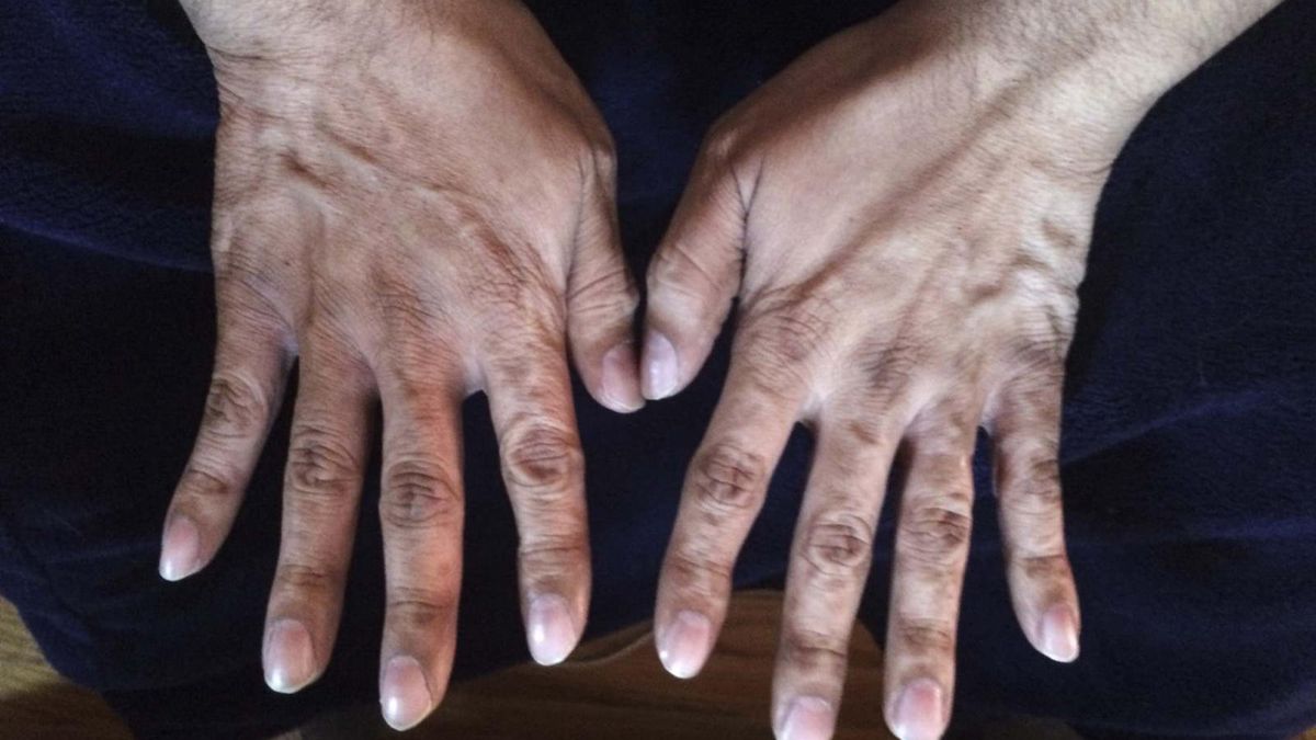 Wygląd paznokci może zwiastować raka