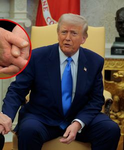 Co się stało? Tajemniczy siniak na dłoni Trumpa