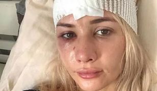 Beata Grucela z "Love Island" ma obrażenia głowy. Trafiła do szpitala