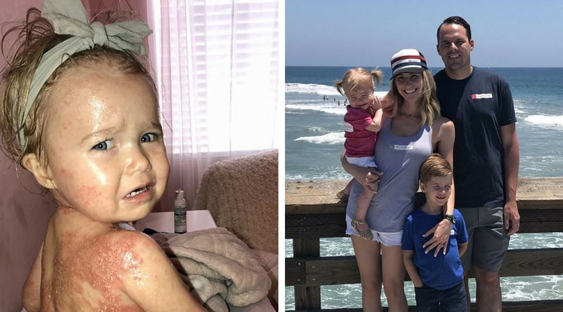 Musi kąpać swoją córkę co 2 godziny. To najmłodsza pacjentka z tak zaawansowanym stadium choroby