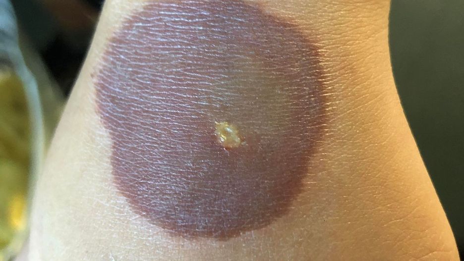 Mama ostrzega przed niebezpiecznym trendem na TikToku. 10-latkę czeka operacja plastyczna