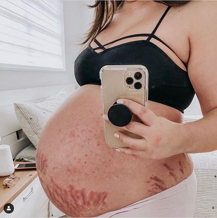 "Bycie mamą oznacza jedno: poświęcenie". Młoda matka pokazuje zdjęcia brzucha z licznymi rozstępami i pokrzywką. "To część mojej drogi"