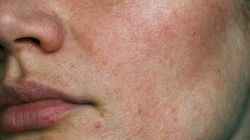 To znak, że wątroba jest na wykończeniu. Widać go gołym okiem