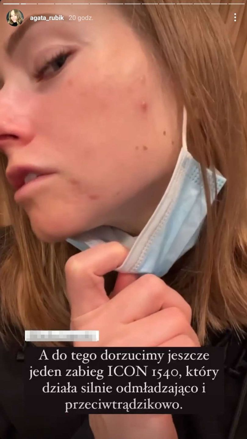 Agata Rubik relacjonuje zabieg laserowy i pokazuje opuchliznę 