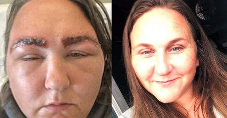 Poszła pofarbować brwi. Reakcja alergiczna sprawiła, że trafiła do szpitala