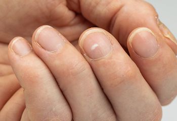 Charakterystyczne plamki na paznokciach. Lepiej ich nie lekceważ