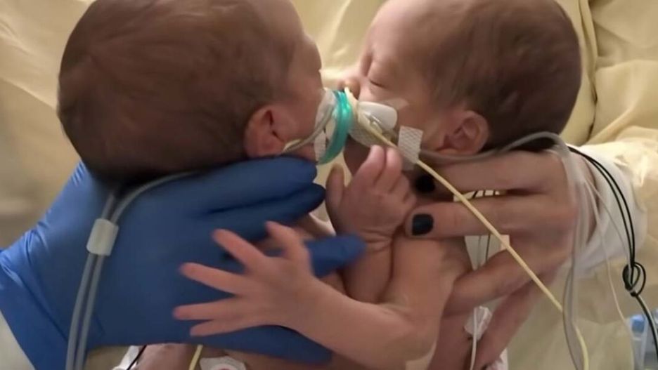 Przyszły na świat jako bliźniaczki syjamskie. Dzięki operacji mogą wreszcie żyć osobno