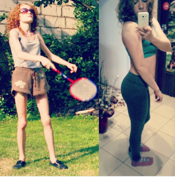 Karolina Dudek - w czasie i po walce z anoreksja