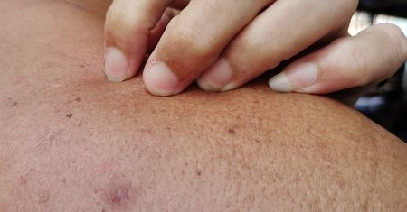 Najczęstszy rak wśród Polaków. Ciche objawy są widoczne na skórze