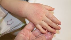 Marsz alergiczny - czym jest, przyczyny, objawy i leczenie