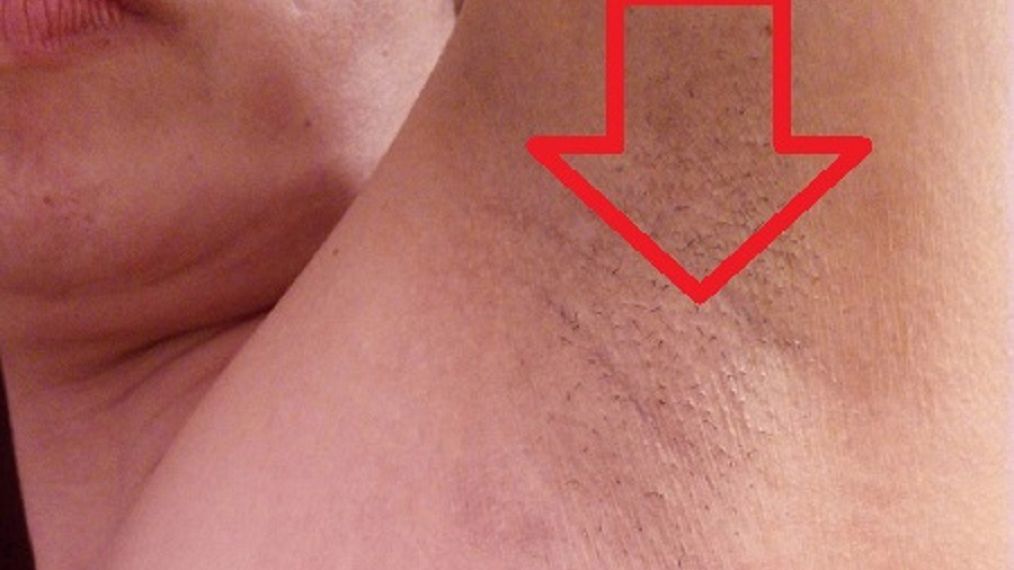 Odczyn poszczepienny przypominający nowotwór piersi. Czy jest się czego obawiać? Wyjaśnia prof. Szuster-Ciesielska