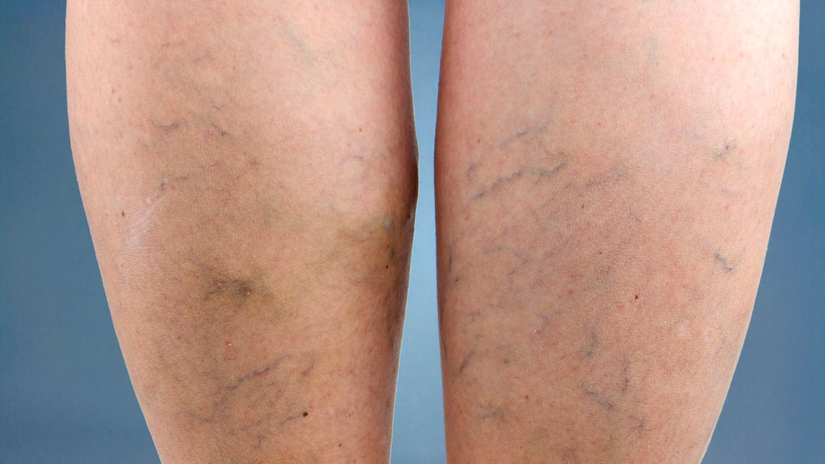 Żylaki występują na nogach niezależnie od wieku
