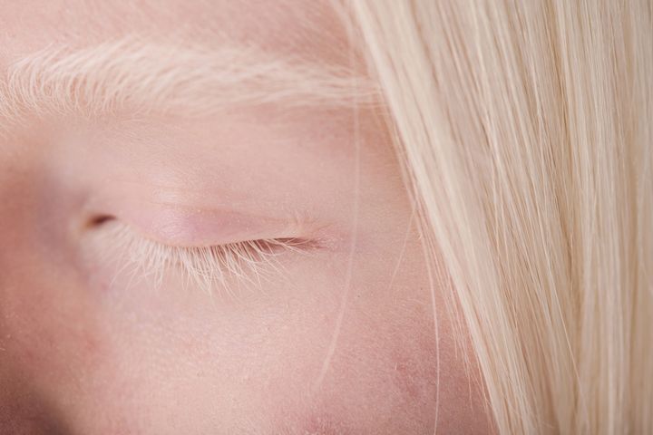 Zespół Chediaka i Higashiego cechuje się częściowym albinizmem