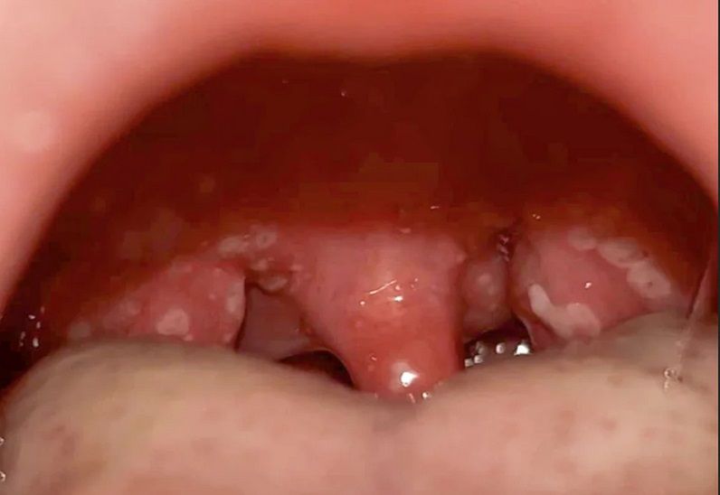 Jama ustna Jamiego była pokryta białymi plamami