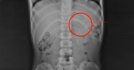 Miał aż 10 cm. Lekarze widzieli coś takiego po raz pierwszy