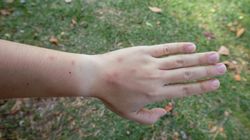 Nie tylko głowa meduzy. Tak rozpoznasz marskość wątroby