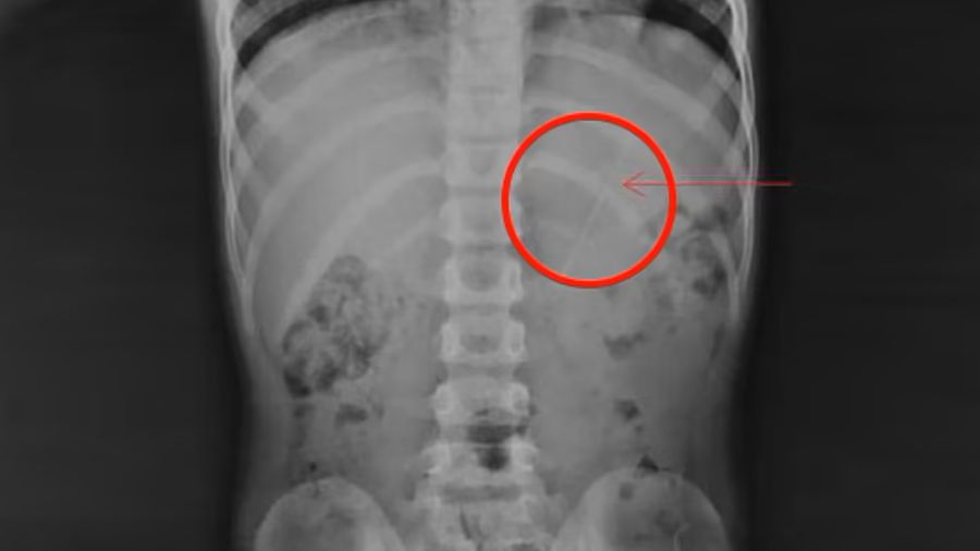 Siedmiolatek połknął 10-centymetrowy ołówek. Pierwszy taki przypadek