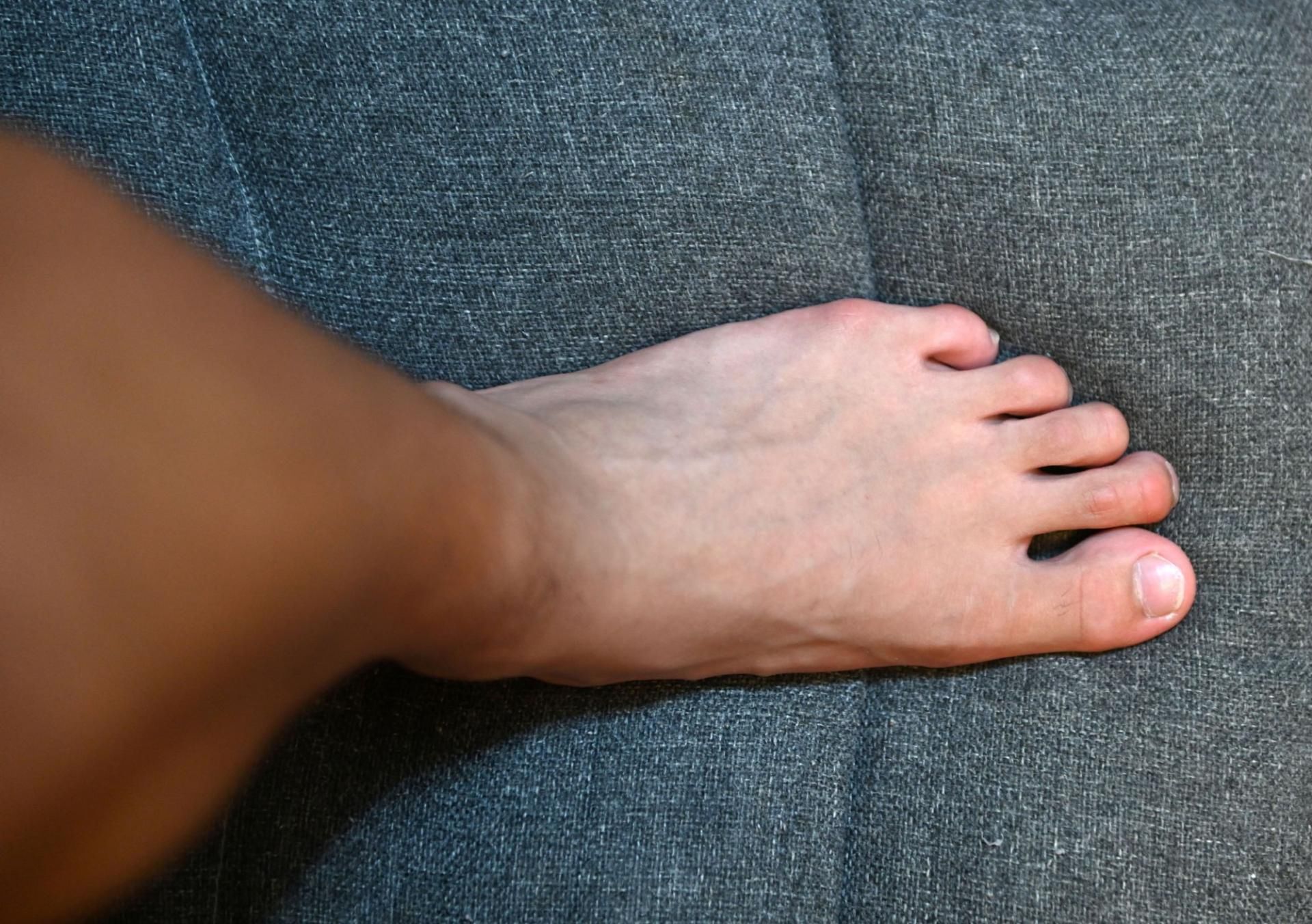 Obrzęki nóg mogą być jednym z objawów chorób serca