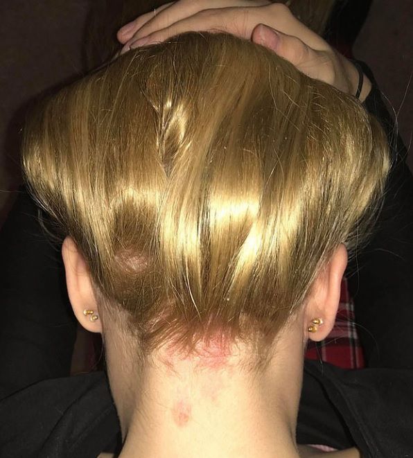 Blizny i łyse placki na głowie nastolatki