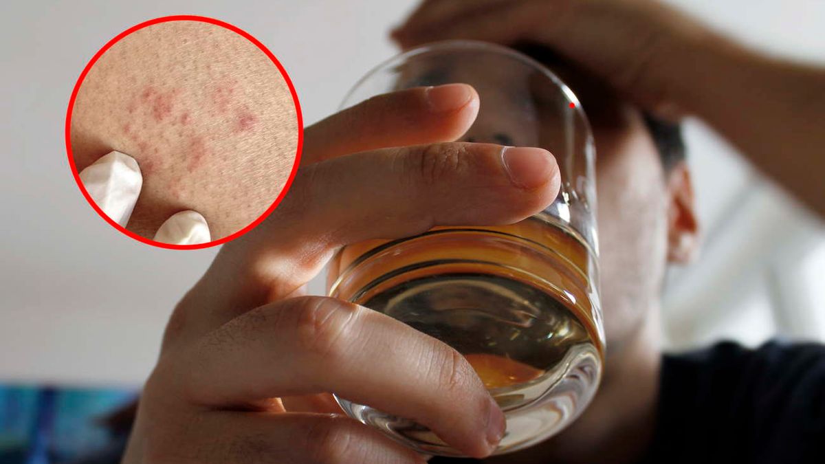 Nietolerancja czy alergia? Uważaj na alkohol