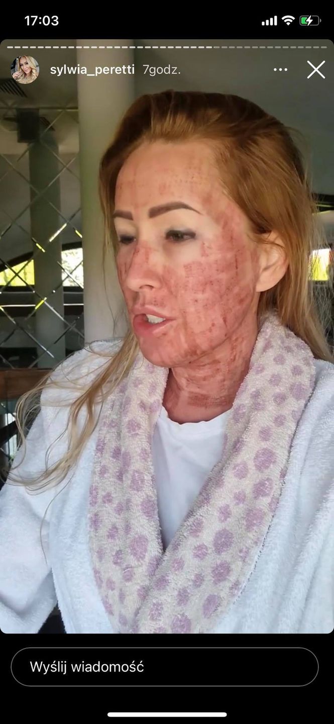 Sylwia Peretti po zabiegu laserowym