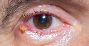Jęczmień na oku