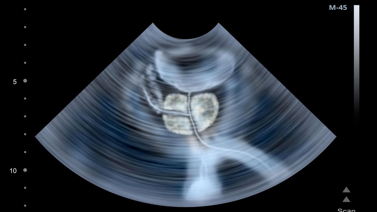 Zdjęcie przedstawia badanie ultrasonograficzne ludzkiej prostaty