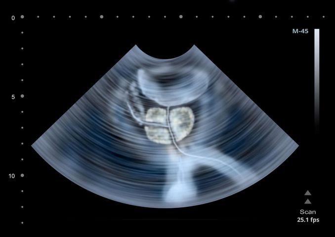 Zdjęcie przedstawia badanie ultrasonograficzne ludzkiej prostaty