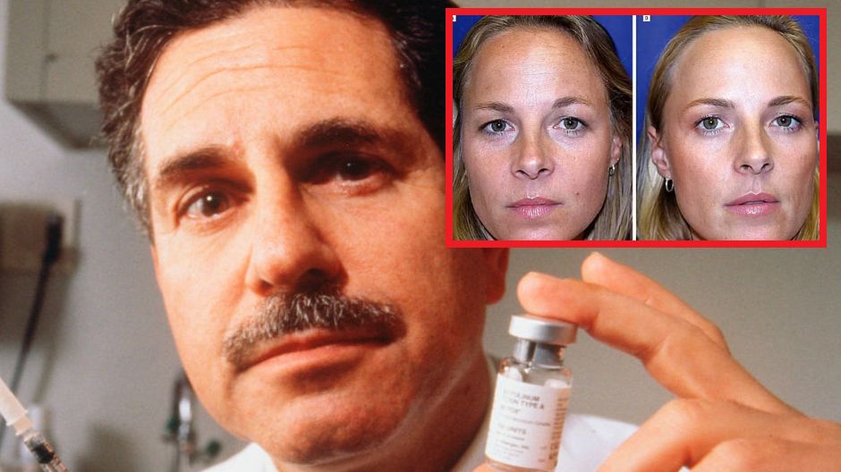 Lekarz pokazał jak działa botoks.