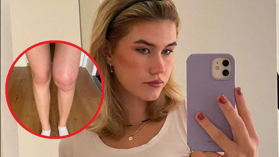 Rezonans magnetyczny wykazał rzadką i agresywną formę kostniakomięsaka