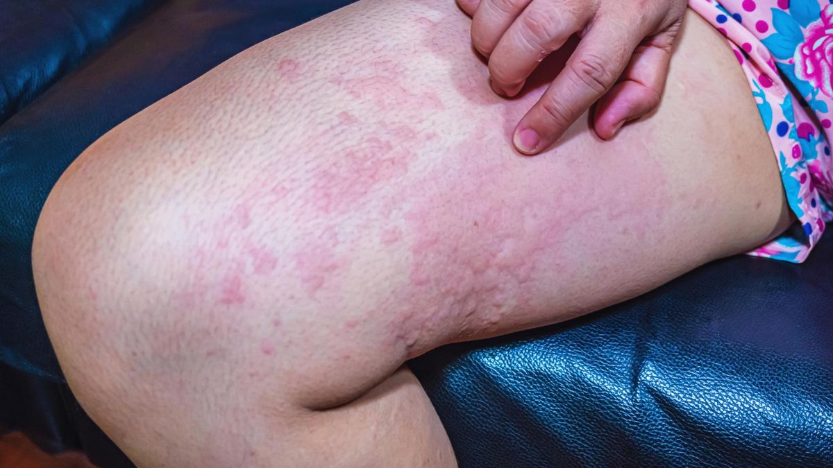 Objawy COVID-19 mogą pojawić się skórze. To tzw. covidowe wysypki