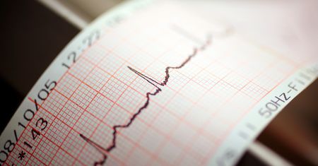 Sztuczna inteligencja wesprze lekarzy. AI "nakarmione" danymi z EKG
