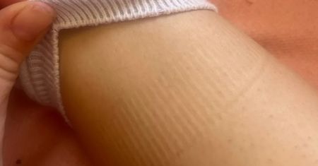 Widzisz takie ślady po skarpetkach? Flebolog przestrzega