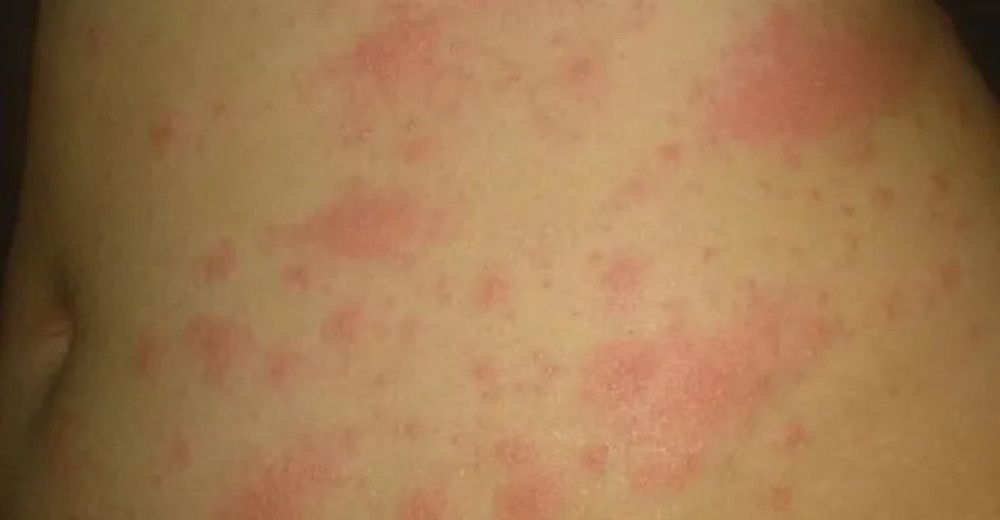 Najczęściej obserwowana u zakażonych wysypka 