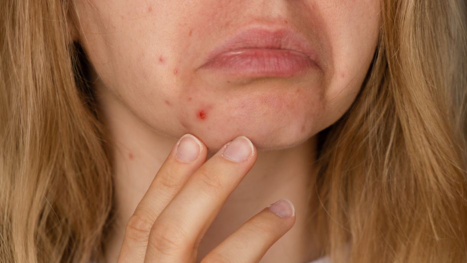 Unrecognizable woman upset showing her acne on face. Acceptance real skin imperfection Close-up acne on woman's face with rash skin ,scar and spot that allergic to cosmetics. Problem skincare and health concept. Wrinkles, melasma, dark spots, freckles, dry skin, acne blackheads on face middle age women chin acne problem skin
Unrecognizable woman upset smiling showing her acne on face. Acceptance real skin imperfection Close-up acne on woman's face with rash skin ,scar and spot that allergic to cosmetics. Problem skincare and health concept. Wrinkles, melasma, dark spots, freckles, dry skin, acne blackheads on face middle age women chin acne problem. pimples on the beard. problem skin in a young girl. hormonal misbalance. Skin disorders lead to depression and insecurities in women
acne, face, problem, skin, woman, health, girl, portrait, skincare, unhappy, care, dermatology, facial, female, pimple, treatment, young, pimples, skin care, blemish, concept, blackhead, cosmetology, healthy, hygiene, infection, spot, adult, caucasian, clean, hyperpigmentation, mark, post, post-inflammatory, problematic, scarring, scars, skin blemishes, spots, acceptance, imperfect, real people, candid, scar, real skin, imperfection, braces, unretouched, skin positivity, hormonal disbalance, acne, face, problem, skin, woman, health, girl, portrait, skincare, unhappy, care, dermatology, facial, female, pimple, treatment, young, pimples, skin care, blemish, concept, blackhead, cosmetology, healthy, hygiene, infection, spot, adult, caucasian, clean, hyperpigmentation, mark, post, post-inflammatory, problematic, scarring, scars, skin blemishes, spots, acceptance
