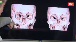 Tak wygląda czaszka Chalidowa przed i po operacji