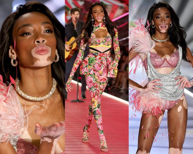 Modelka z bielactwem triumfuje na wybiegu Victoria's Secret